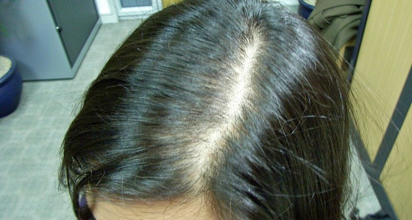 Назвали способ остановить выпадение волос после ковида 