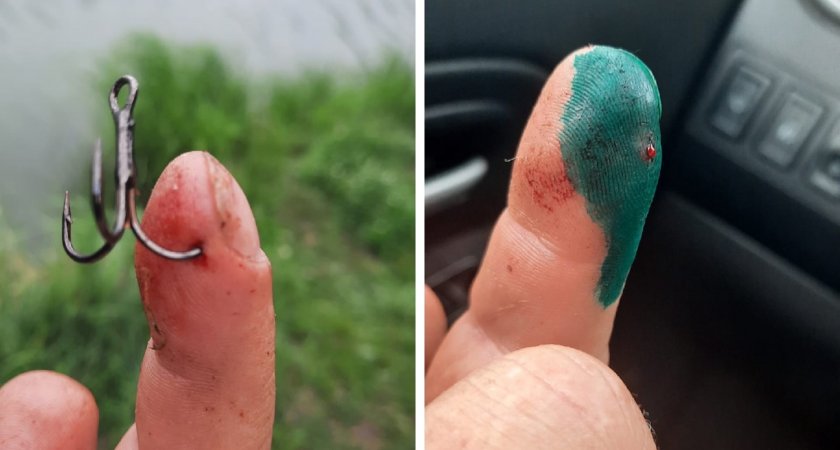 «Чуть не чокнулся»: пензенцу на живую оперировали палец в травмпункте 