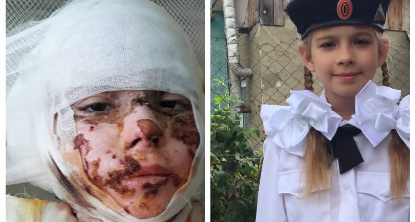 В Пензе 7-летней девочке, пострадавшей от взрыва газового баллона, нужна помощь