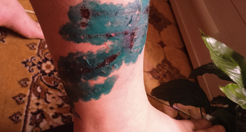 "Валили и кусали": пензенец показал жуткие кадры после нападения на него собак