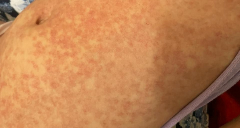 Минздрав: число зараженных корью в Пензенской области по-прежнему растет 