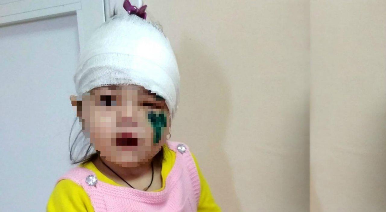 Пензенская обезьяна жестко искусала лицо двухлетней девочки