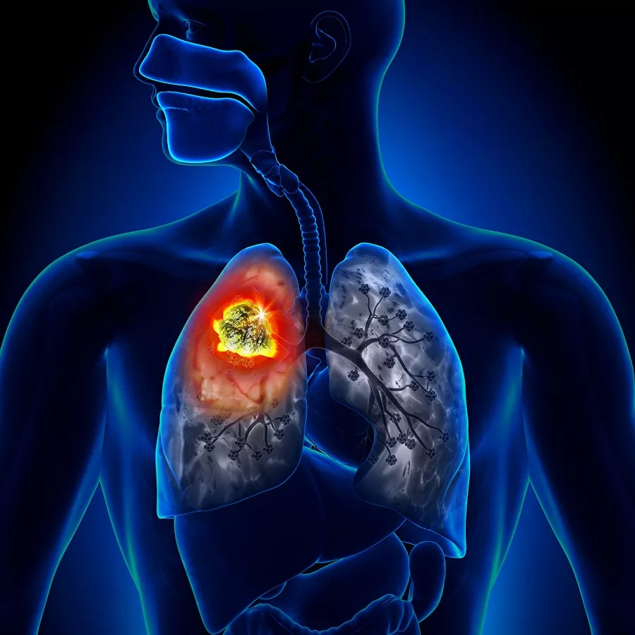 Пензенцам озвучили простой способ избежать рака легких