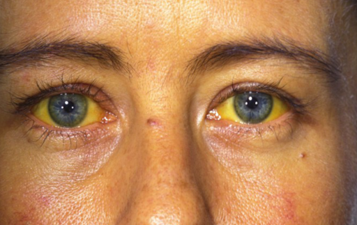 Озвучена статистика по гепатиту в Пензенской области за минувший год