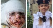 В Пензе 7-летней девочке, пострадавшей от взрыва газового баллона, нужна помощь