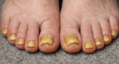 Толстые и жёлтые ногти: обычный фен выручает ноги - эффект лучше чем от дорогущих кремов и салонных процедур