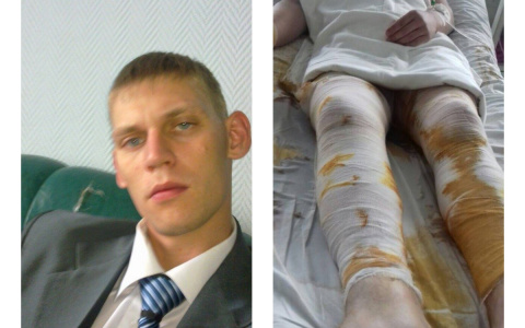 Обгоревшему сварщику "Горводоканал" на больничном будет платить всю зарплату