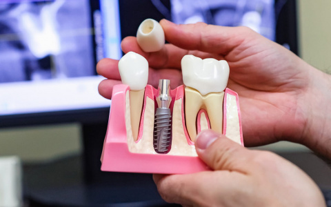 Имплантация зубов в Пензе: больно или нет?