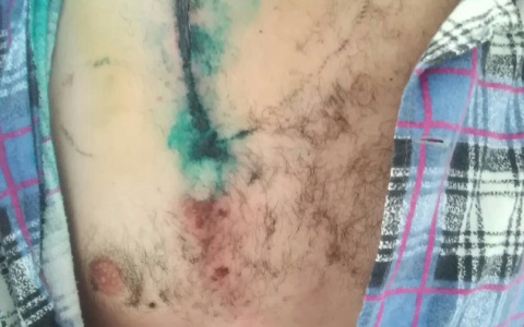 Николай Тюкин после удара молнии ждет появления невероятных способностей