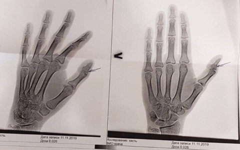 Официально: в пензенской поликлинике накажут виновных, отправивших мальчика с переломом домой