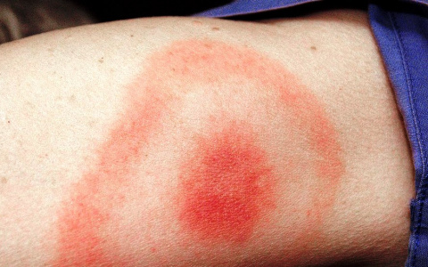 Теперь и болезнь Лайма: не только коронавируса боятся пензенцы