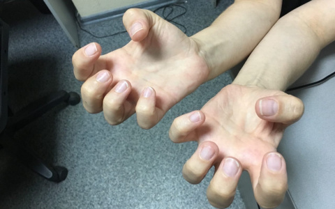 17% пензенцев грызут ногти: какая опасность им грозит