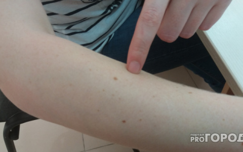 Врач рассказал, какие изменения в родинке выдают рак кожи