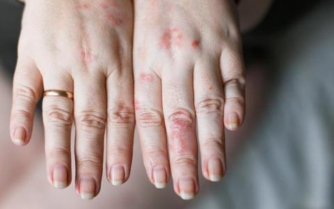 Внимание на руки: назван новый неявный признак коронавируса