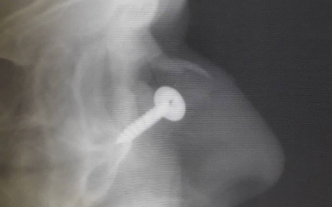 «Споткнулся. Упал. В голове саморез»: удивительная история пензенского врача