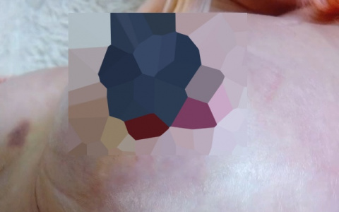 «Соски сползли!» Пензячка поделилась фото и видео после неудачной операции на груди