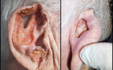 Пензенский врач о запоздалом обращении в больницу: «Думал, что онкология»