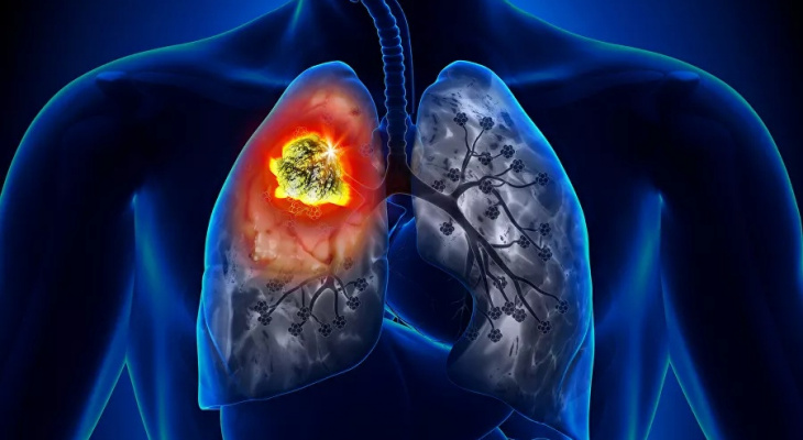 Пензенцам озвучили простой способ избежать рака легких