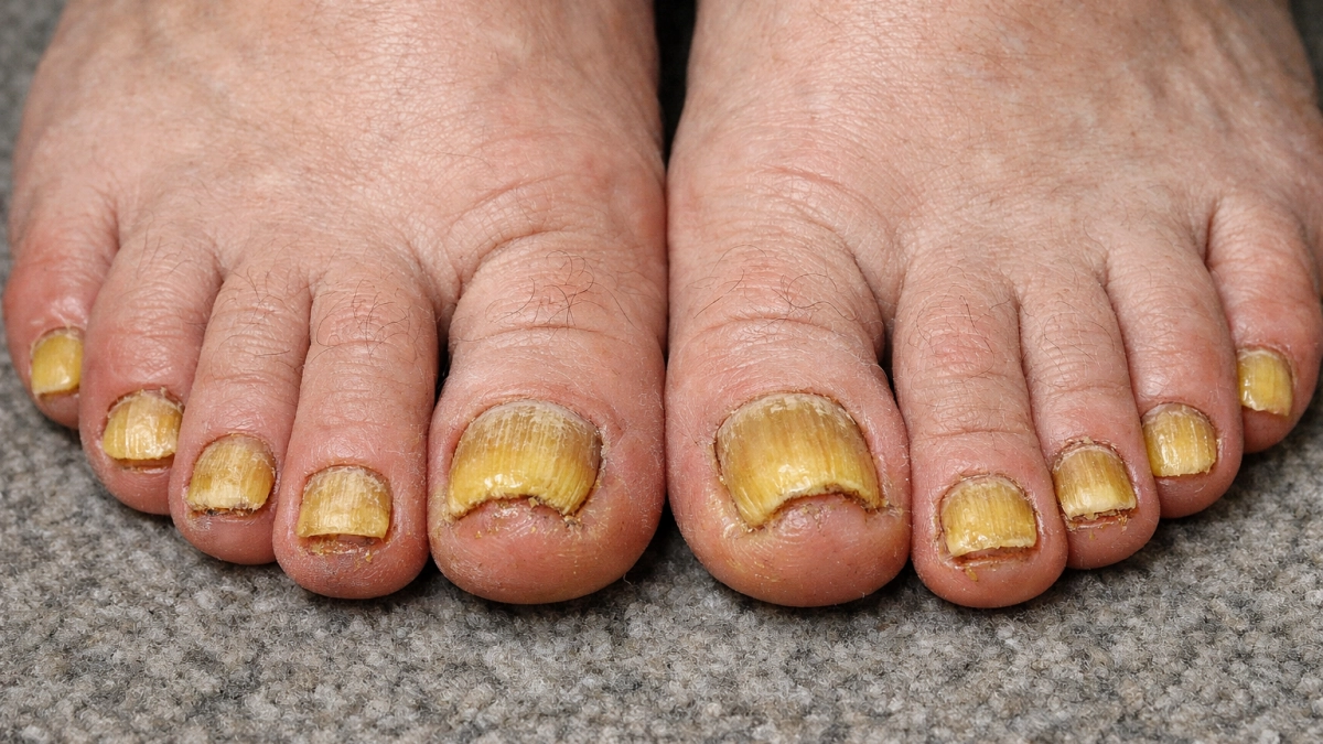 Толстые и жёлтые ногти: обычный фен выручает ноги - эффект лучше чем от дорогущих кремов и салонных процедур