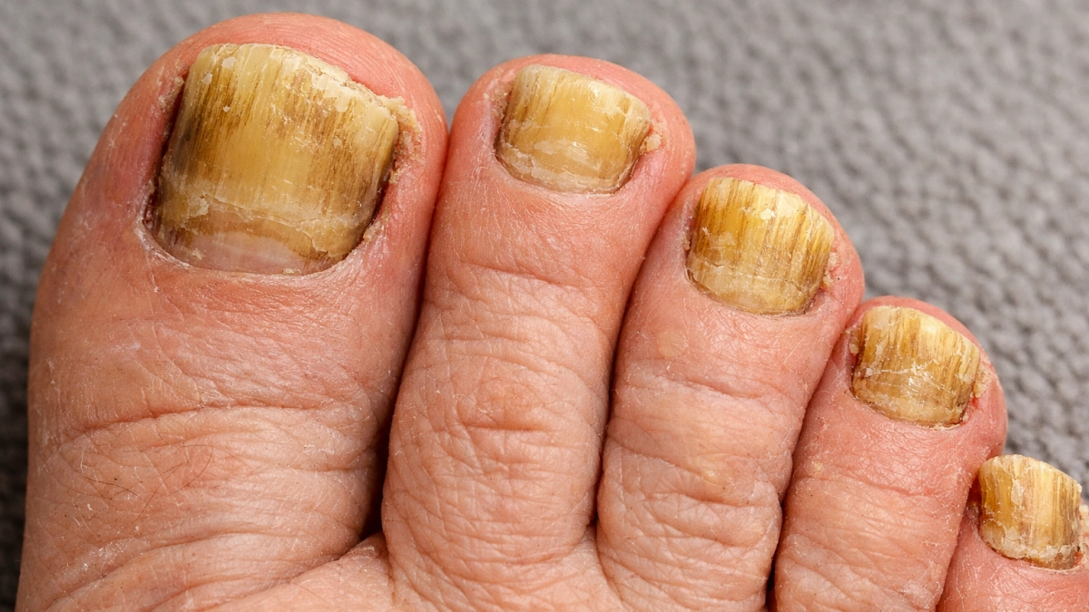 Толстые и жёлтые ногти:  обычный фрукт выручает ноги - потратила 100 рублей, а эффект лучше чем от салонных процедур