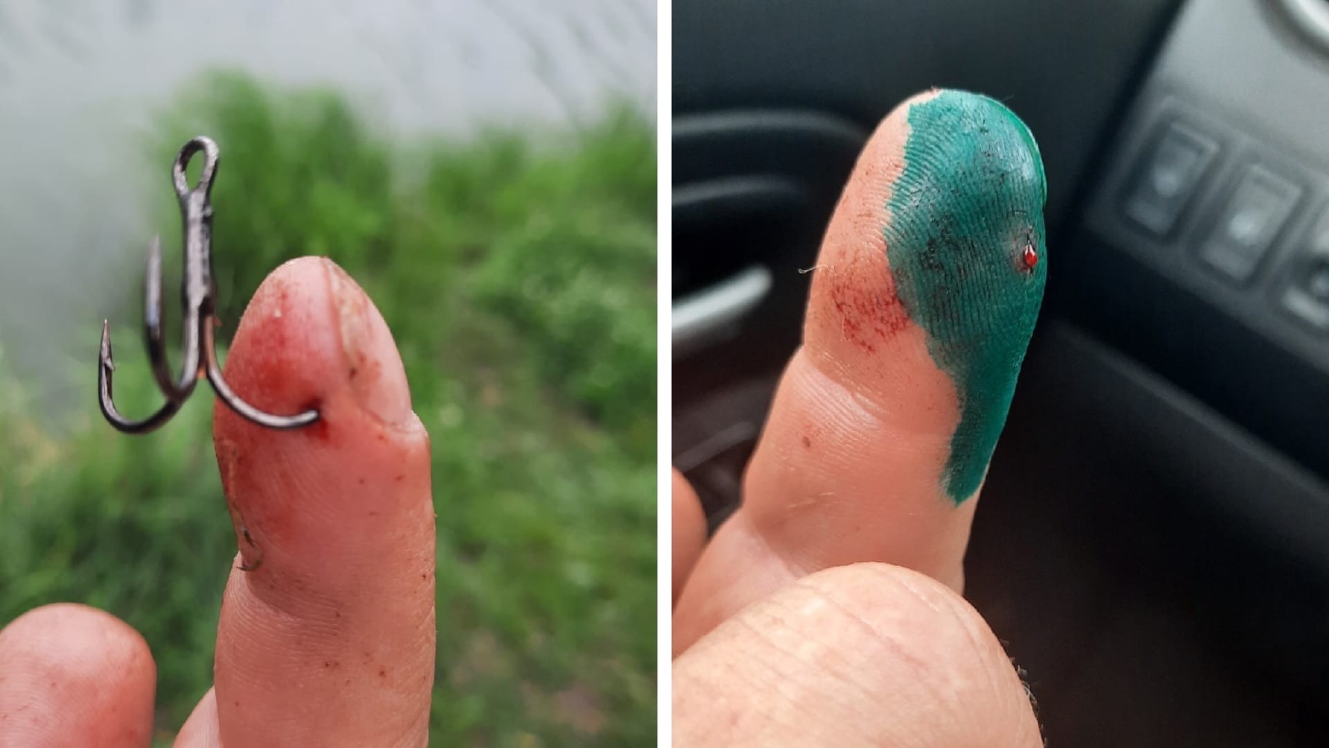 «Чуть не чокнулся»: пензенцу на живую оперировали палец в травмпункте 